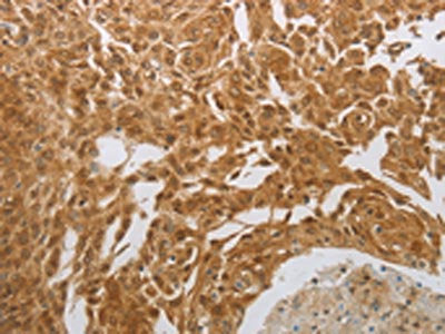 The image on the left is immunohistochemistry of paraffin-embedded Human cervical cancer tissue using NIT2 Antibody(NIT2 Antibody) at dilution 1/40, on the right is treated with synthetic peptide. (Original magnification: ×200)Rabbit anti-Human NIT2 Polyclonal Antibody