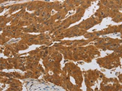 The image on the left is immunohistochemistry of paraffin-embedded Human ovarian cancer tissue using the antibody Antibody) at dilution 1/40, on the right is treated with synthetic peptide. (Original magnification: ×200)Rabbit anti-Human NIT2 Polyclonal Antibody