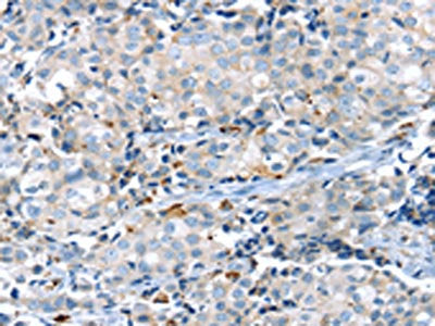 The image on the left is immunohistochemistry of paraffin-embedded Human breast cancer tissue using KCNG3 Antibody(KCNG3 Antibody) at dilution 1/25, on the right is treated with synthetic peptide. (Original magnification: ×200)Rabbit anti-Human KCNG3 Polyclonal Antibody