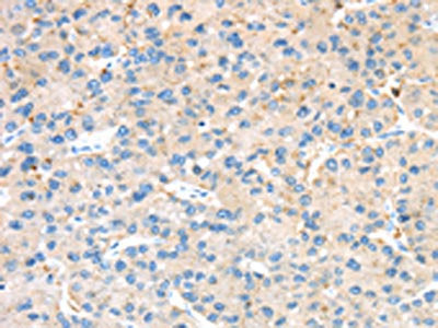 The image on the left is immunohistochemistry of paraffin-embedded Human liver cancer tissue using the antibody Antibody) at dilution 1/25, on the right is treated with synthetic peptide. (Original magnification: ×200)Rabbit anti-Human KCNG3 Polyclonal Antibody