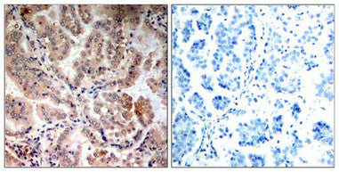 Immunohistochemical analysis of paraffin-embedded human breast carcinoma tissue using AMPKa1/AMPKa2(Ab-174/172) Antibody(left) or the same antibody preincubated with blocking peptide(right).Rabbit anti-Human PRKAA1 Polyclonal Antibody