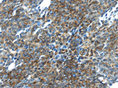 The image on the left is immunohistochemistry of paraffin-embedded Human ovarian cancer tissue using TGM5 Antibody(TGM5 Antibody) at dilution 1/20, on the right is treated with fusion protein. (Original magnification: ×200)Rabbit anti-Human TGM5 Polyclonal Antibody