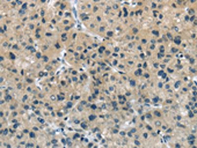The image on the left is immunohistochemistry of paraffin-embedded Human liver cancer tissue using the antibody Antibody) at dilution 1/20, on the right is treated with fusion protein. (Original magnification: ×200)Rabbit anti-Human TGM5 Polyclonal Antibody