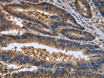 The image on the left is immunohistochemistry of paraffin-embedded Human colon cancer tissue using EPOR Antibody(EPOR Antibody) at dilution 1/30, on the right is treated with synthetic peptide. (Original magnification: ×200)Rabbit anti-Human EPOR Polyclonal Antibody