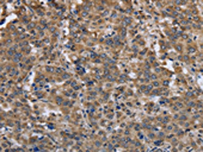The image on the left is immunohistochemistry of paraffin-embedded Human liver cancer tissue using the antibody Antibody) at dilution 1/30, on the right is treated with synthetic peptide. (Original magnification: ×200)Rabbit anti-Human EPOR Polyclonal Antibody