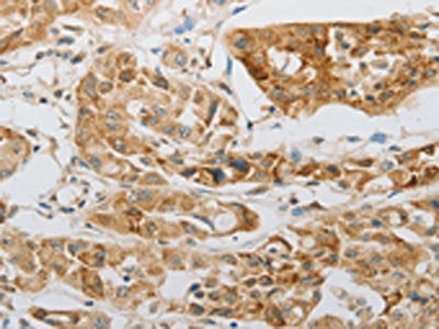 The image on the left is immunohistochemistry of paraffin-embedded Human lung cancer tissue using LEPR Antibody(LEPR Antibody) at dilution 1/20, on the right is treated with synthetic peptide. (Original magnification: ×200)