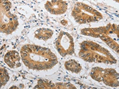 The image on the left is immunohistochemistry of paraffin-embedded Human colon cancer tissue using the antibody Antibody) at dilution 1/20, on the right is treated with synthetic peptide. (Original magnification: ×200)