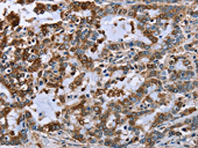 The image on the left is immunohistochemistry of paraffin-embedded Human liver cancer tissue using IMPDH2 Antibody(IMPDH2 Antibody) at dilution 1/60, on the right is treated with fusion protein. (Original magnification: ×200)Rabbit anti-Human IMPDH2 Polyclonal Antibody