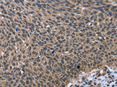 The image on the left is immunohistochemistry of paraffin-embedded Human lung cancer tissue using the antibody Antibody) at dilution 1/60, on the right is treated with fusion protein. (Original magnification: ×200)Rabbit anti-Human IMPDH2 Polyclonal Antibody