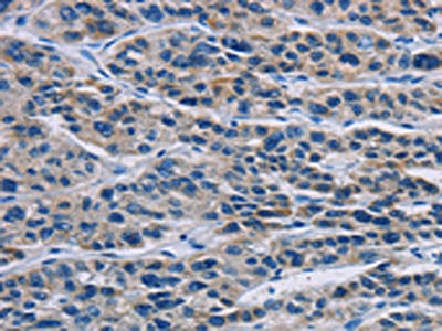 The image on the left is immunohistochemistry of paraffin-embedded Human liver cancer tissue using MSH5 Antibody(MSH5 Antibody) at dilution 1/30, on the right is treated with fusion protein. (Original magnification: ×200)Rabbit anti-Human MSH5 Polyclonal Antibody