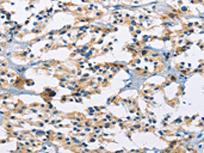 The image on the left is immunohistochemistry of paraffin-embedded Human thyroid cancer tissue using the antibody Antibody) at dilution 1/30, on the right is treated with fusion protein. (Original magnification: ×200)Rabbit anti-Human MSH5 Polyclonal Antibody