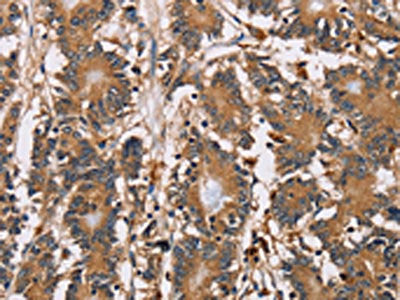 The image on the left is immunohistochemistry of paraffin-embedded Human colon cancer tissue using HTR3C Antibody(HTR3C Antibody) at dilution 1/40, on the right is treated with fusion protein. (Original magnification: ×200)Rabbit anti-Human HTR3C Polyclonal Antibody