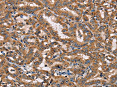 The image on the left is immunohistochemistry of paraffin-embedded Human thyroid cancer tissue using the antibody Antibody) at dilution 1/40, on the right is treated with fusion protein. (Original magnification: ×200)Rabbit anti-Human HTR3C Polyclonal Antibody