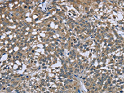 The image on the left is immunohistochemistry of paraffin-embedded Human cervical cancer tissue using PTK2B Antibody(PTK2B Antibody) at dilution 1/50, on the right is treated with fusion protein. (Original magnification: ×200)Rabbit anti-Human PTK2B Polyclonal Antibody
