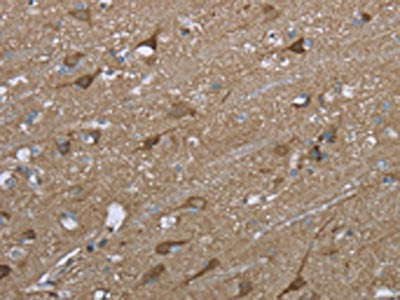 The image on the left is immunohistochemistry of paraffin-embedded Human brain tissue using the antibody Antibody) at dilution 1/50, on the right is treated with fusion protein. (Original magnification: ×200)Rabbit anti-Human PTK2B Polyclonal Antibody