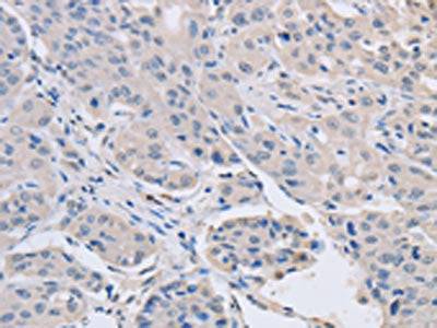 The image on the left is immunohistochemistry of paraffin-embedded Human lung cancer tissue using ABLIM1 Antibody(ABLIM1 Antibody) at dilution 1/30, on the right is treated with fusion protein. (Original magnification: ×200)