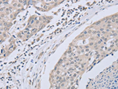 The image on the left is immunohistochemistry of paraffin-embedded Human breast cancer tissue using the antibody Antibody) at dilution 1/30, on the right is treated with fusion protein. (Original magnification: ×200)