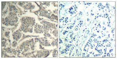 Immunohistochemical analysis of paraffin-embedded human breast carcinoma tissue using cofilin1/cofilin2(Ab-88) Antibody(left) or the same antibody preincubated with blocking peptide(right).Rabbit anti-Human CFL1/CFL2 Polyclonal Antibody