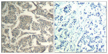 Immunohistochemical analysis of paraffin-embedded human breast carcinoma tissue using cofilin1/cofilin2(Ab-88) Antibody(left) or the same antibody preincubated with blocking peptide(right).Rabbit anti-Human CFL1/CFL2 Polyclonal Antibody