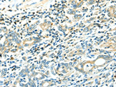 The image on the left is immunohistochemistry of paraffin-embedded Human gastic cancer tissue using LYVE1 Antibody(LYVE1 Antibody) at dilution 1/15, on the right is treated with fusion protein. (Original magnification: ×200)