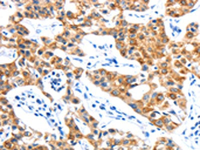 The image on the left is immunohistochemistry of paraffin-embedded Human lung cancer tissue using the antibody Antibody) at dilution 1/15, on the right is treated with fusion protein. (Original magnification: ×200)