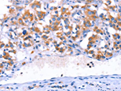 The image on the left is immunohistochemistry of paraffin-embedded Human thyroid cancer tissue using SGK2 Antibody(SGK2 Antibody) at dilution 1/15, on the right is treated with synthetic peptide. (Original magnification: ×200)Rabbit anti-Human SGK2 Polyclonal Antibody