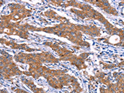 The image on the left is immunohistochemistry of paraffin-embedded Human gastic cancer tissue using the antibody Antibody) at dilution 1/15, on the right is treated with synthetic peptide. (Original magnification: ×200)Rabbit anti-Human SGK2 Polyclonal Antibody