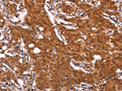 The image on the left is immunohistochemistry of paraffin-embedded Human gastric cancer tissue using APMAP Antibody(APMAP Antibody) at dilution 1/30, on the right is treated with synthetic peptide. (Original magnification: ×200)Rabbit anti-Human APMAP Polyclonal Antibody
