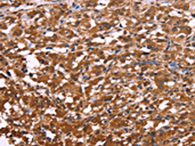 The image on the left is immunohistochemistry of paraffin-embedded Human thyroid cancer tissue using the antibody Antibody) at dilution 1/30, on the right is treated with synthetic peptide. (Original magnification: ×200)Rabbit anti-Human APMAP Polyclonal Antibody