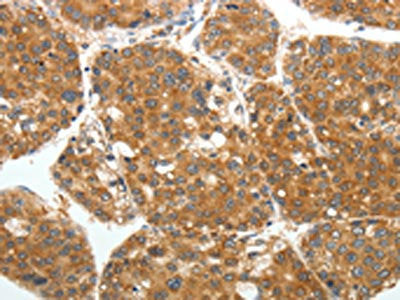 The image on the left is immunohistochemistry of paraffin-embedded Human liver cancer tissue using RARA Antibody(RARA Antibody) at dilution 1/40, on the right is treated with fusion protein. (Original magnification: ×200)Rabbit anti-Human RARA Polyclonal Antibody