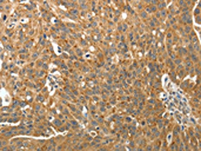 The image on the left is immunohistochemistry of paraffin-embedded Human ovarian cancer tissue using the antibody Antibody) at dilution 1/40, on the right is treated with fusion protein. (Original magnification: ×200)Rabbit anti-Human RARA Polyclonal Antibody