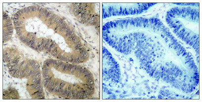 Immunohistochemical analysis of paraffin-embedded human colon carcinoma tissue using IKK a(Phospho-Thr23) Antibody(left) or the same antibody preincubated with blocking peptide(right).Rabbit anti-Human CHUK Polyclonal Antibody