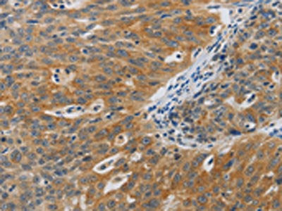 The image on the left is immunohistochemistry of paraffin-embedded Human ovarian cancer tissue using F2R Antibody(F2R Antibody) at dilution 1/40, on the right is treated with synthetic peptide. (Original magnification: ×200)Rabbit anti-Human F2R Polyclonal Antibody