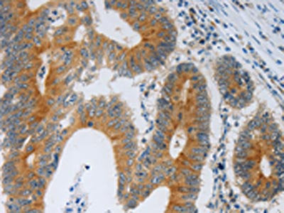The image on the left is immunohistochemistry of paraffin-embedded Human colon cancer tissue using the antibody Antibody) at dilution 1/40, on the right is treated with synthetic peptide. (Original magnification: ×200)Rabbit anti-Human F2R Polyclonal Antibody