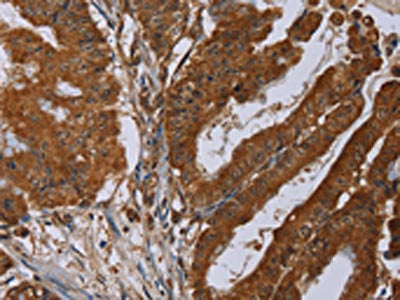 The image on the left is immunohistochemistry of paraffin-embedded Human esophagus cancer tissue using the antibody Antibody) at dilution 1/30, on the right is treated with synthetic peptide. (Original magnification: ×200)Rabbit anti-Human SLC22A2 Polyclonal Antibody