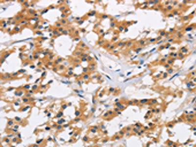 The image is immunohistochemistry of paraffin-embedded Human thyroid cancer tissue using the antibody Antibody) at dilution 1/20. (Original magnification: ×200)