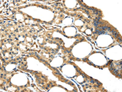 The image on the left is immunohistochemistry of paraffin-embedded Human thyroid cancer tissue using ISM2 Antibody(ISM2 Antibody) at dilution 1/45, on the right is treated with synthetic peptide. (Original magnification: ×200)