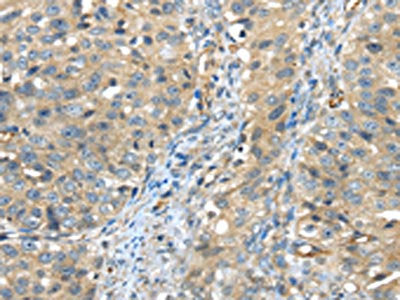 The image on the left is immunohistochemistry of paraffin-embedded Human breast cancer tissue using the antibody Antibody) at dilution 1/45, on the right is treated with synthetic peptide. (Original magnification: ×200)