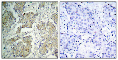 Immunohistochemical analysis of paraffin-embedded human breast carcinoma tissue using VEGFR2(Phospho-Tyr1214) Antibody(left) or the same antibody preincubated with blocking peptide(right).