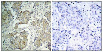 Immunohistochemical analysis of paraffin-embedded human breast carcinoma tissue using VEGFR2(Phospho-Tyr1214) Antibody(left) or the same antibody preincubated with blocking peptide(right).