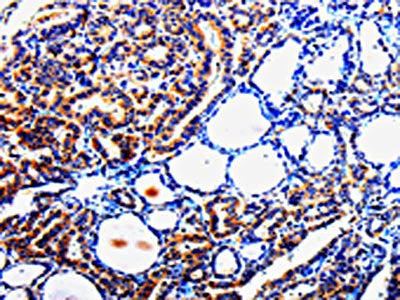 The image is immunohistochemistry of paraffin-embedded Human thyroid cancer tissue using TUBB3 Antibody(TUBB3 Antibody) at dilution 1/25. (Original magnification: ×200)Rabbit anti-Human TUBB3 Polyclonal Antibody