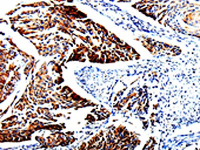The image is immunohistochemistry of paraffin-embedded Human cervical cancer tissue using the antibody Antibody) at dilution 1/25. (Original magnification: ×200)Rabbit anti-Human TUBB3 Polyclonal Antibody