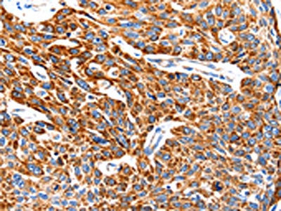 The image on the left is immunohistochemistry of paraffin-embedded Human esophagus cancer tissue using TRAP1 Antibody(TRAP1 Antibody) at dilution 1/100, on the right is treated with fusion protein. (Original magnification: ×200)Rabbit anti-Human TRAP1 Polyclonal Antibody