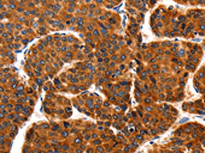 The image on the left is immunohistochemistry of paraffin-embedded Human liver cancer tissue using the antibody Antibody) at dilution 1/100, on the right is treated with fusion protein. (Original magnification: ×200)Rabbit anti-Human TRAP1 Polyclonal Antibody