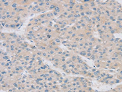 The image on the left is immunohistochemistry of paraffin-embedded Human liver cancer tissue using TPH2 Antibody(TPH2 Antibody) at dilution 1/20, on the right is treated with synthetic peptide. (Original magnification: ×200)Rabbit anti-Human TPH2 Polyclonal Antibody