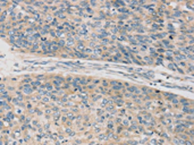 The image on the left is immunohistochemistry of paraffin-embedded Human esophagus cancer tissue using the antibody Antibody) at dilution 1/20, on the right is treated with synthetic peptide. (Original magnification: ×200)Rabbit anti-Human TPH2 Polyclonal Antibody