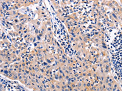 The image on the left is immunohistochemistry of paraffin-embedded Human lung cancer tissue using AKR1B10 Antibody(AKR1B10 Antibody) at dilution 1/30, on the right is treated with fusion protein. (Original magnification: ×200)Rabbit anti-Human AKR1B10 Polyclonal Antibody