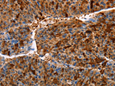 The image on the left is immunohistochemistry of paraffin-embedded Human liver cancer tissue using the antibody Antibody) at dilution 1/30, on the right is treated with fusion protein. (Original magnification: ×200)Rabbit anti-Human AKR1B10 Polyclonal Antibody