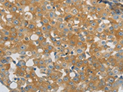 The image on the left is immunohistochemistry of paraffin-embedded Human breast cancer tissue using the antibody Antibody) at dilution 1/40, on the right is treated with synthetic peptide. (Original magnification: ×200)Rabbit anti-Human PPAP2A Polyclonal Antibody