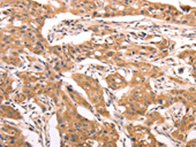 The image on the left is immunohistochemistry of paraffin-embedded Human lung cancer tissue using AASDHPPT Antibody(AASDHPPT Antibody) at dilution 1/30, on the right is treated with fusion protein. (Original magnification: ×200)